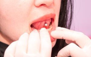 dentist checking patient's oral piercing