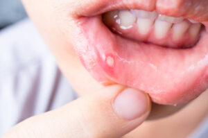 canker sore on lip