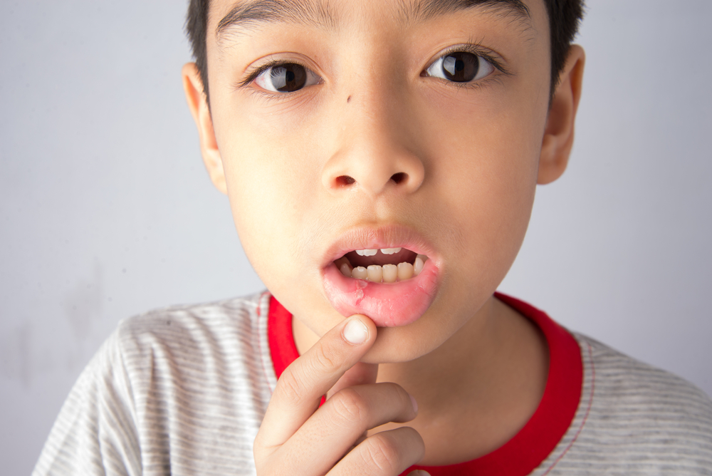 little boy with canker sore on lip