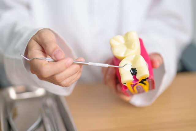 cavity in tooth model