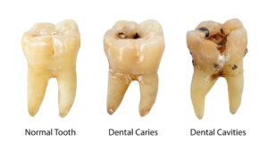 normal tooth vs dental caries vs dental cavities