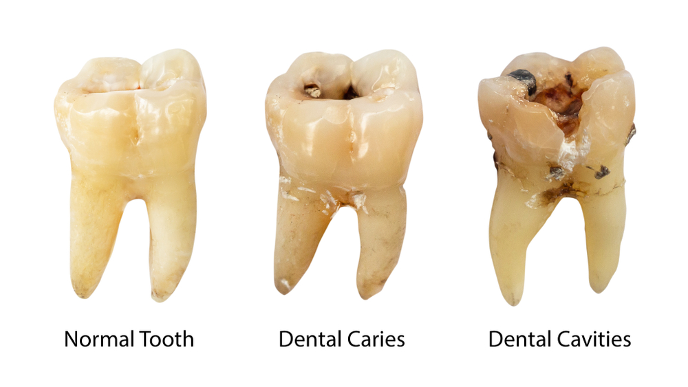 Normal tooth, dental caries, and dental cavities comparison, illustrating the effects of tooth decay relevant to root canal therapy and dental health.