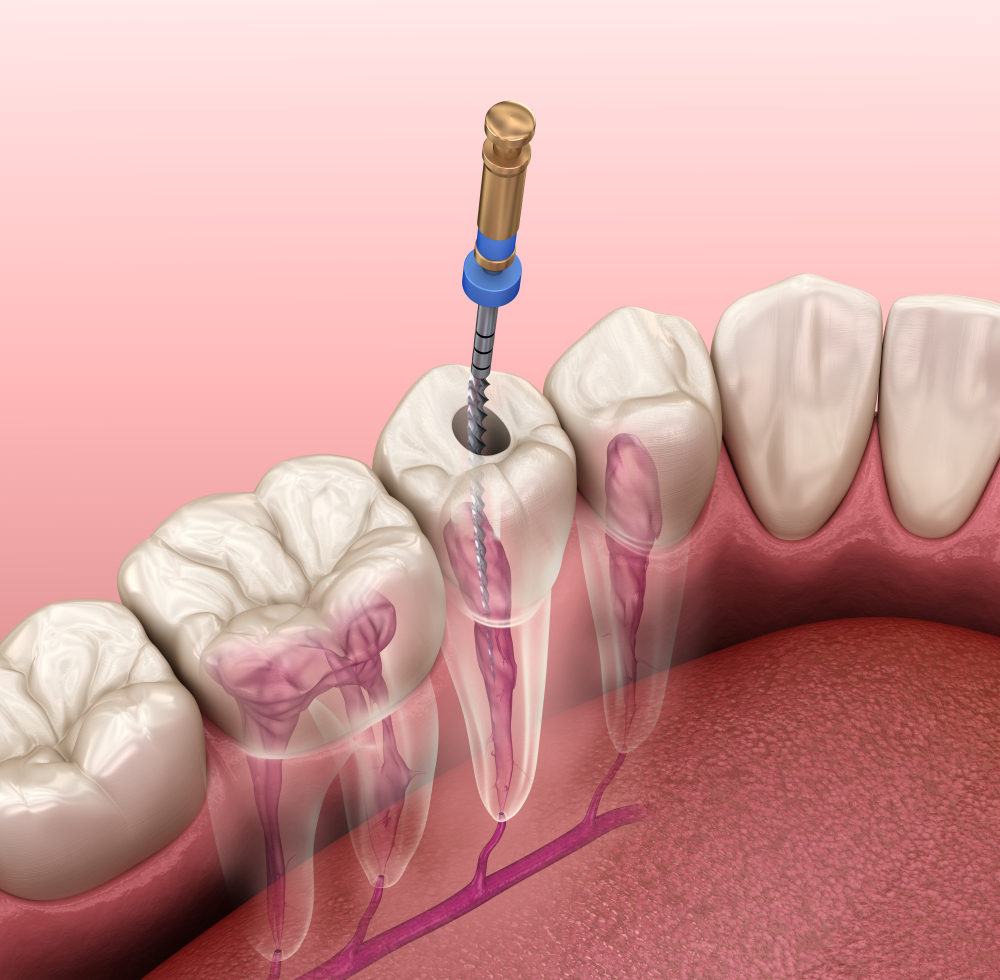 Endodontic,Root,Canal,Treatment,Process.,Medically,Accurate,Tooth,3d,Illustration. Illustration of root canal therapy procedure showing dental drill in tooth, highlighting tooth anatomy and treatment process, relevant to restorative dental care information.