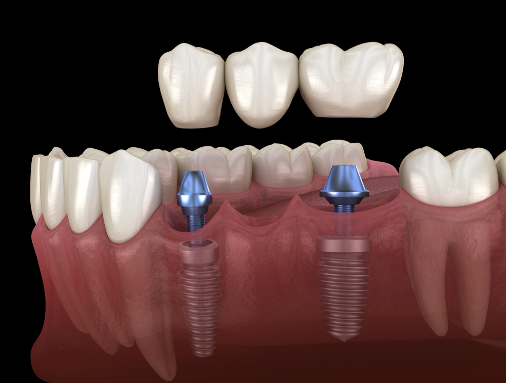 dental bridges supported with implants