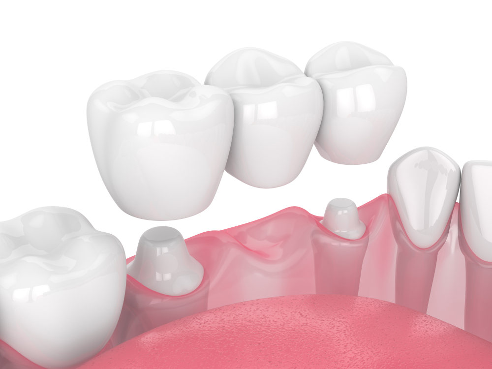 dental bridges