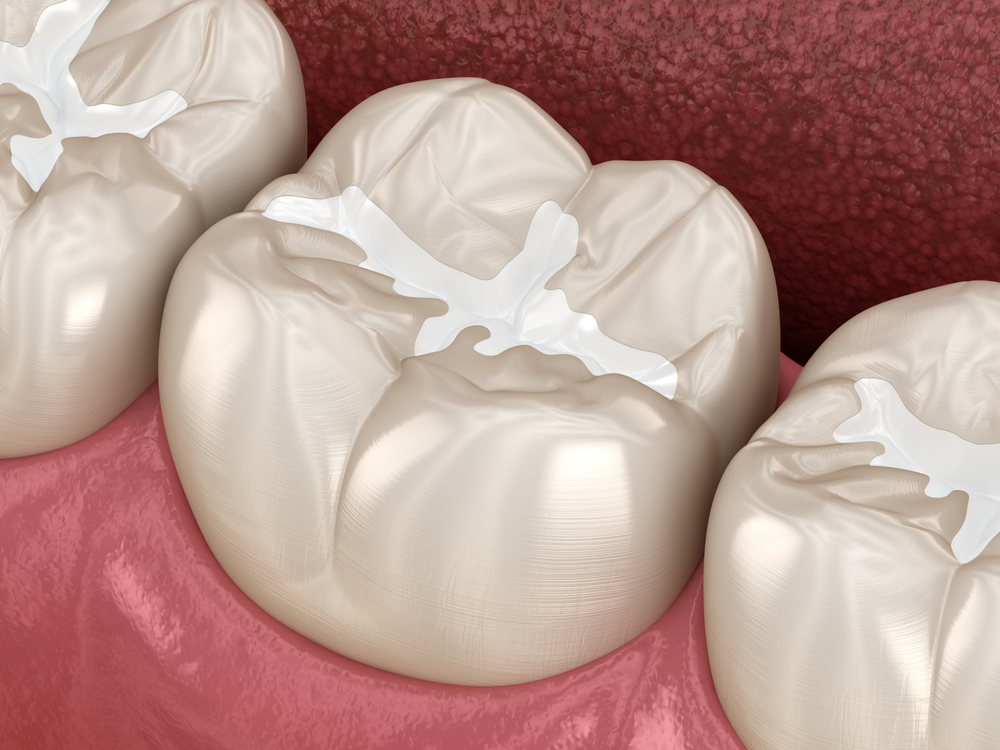 Dental sealants applied on molars, showcasing protective resin coating and natural tooth appearance, emphasizing cavity prevention benefits.