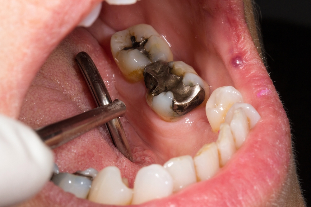 composite dental filling