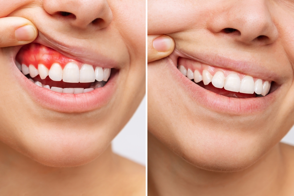 Two,Shots,Of,A,Young,Woman,With,Red,Bleeding,Gums Before and after images of a person showing gum health improvement, highlighting swollen, bleeding gums on the left and healthy gums on the right, illustrating the benefits of scaling and root planing treatment for oral health.