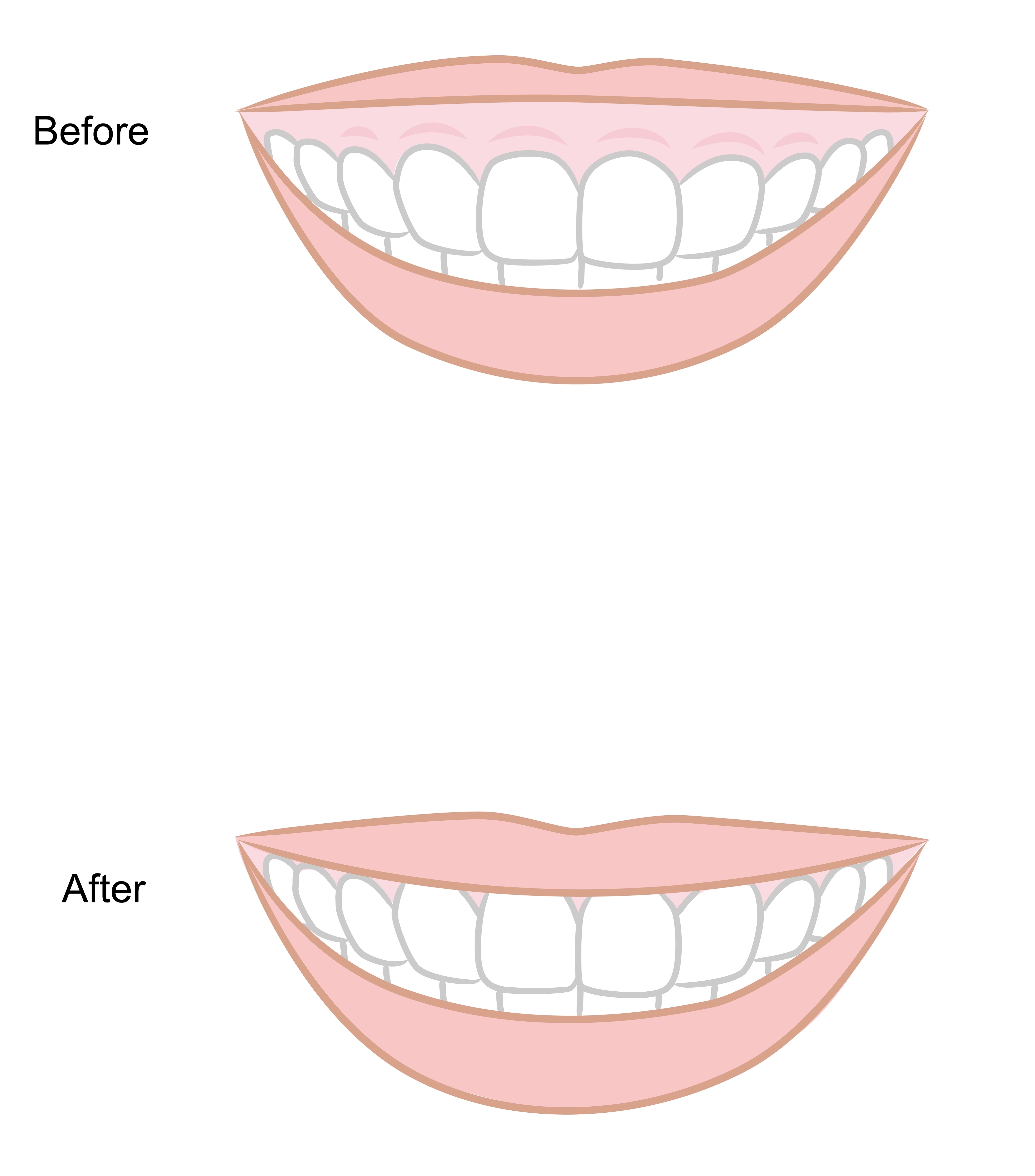 Before and after images of a smile transformation illustrating the effects of crown lengthening, highlighting improved tooth exposure and balanced proportions between teeth and gums.