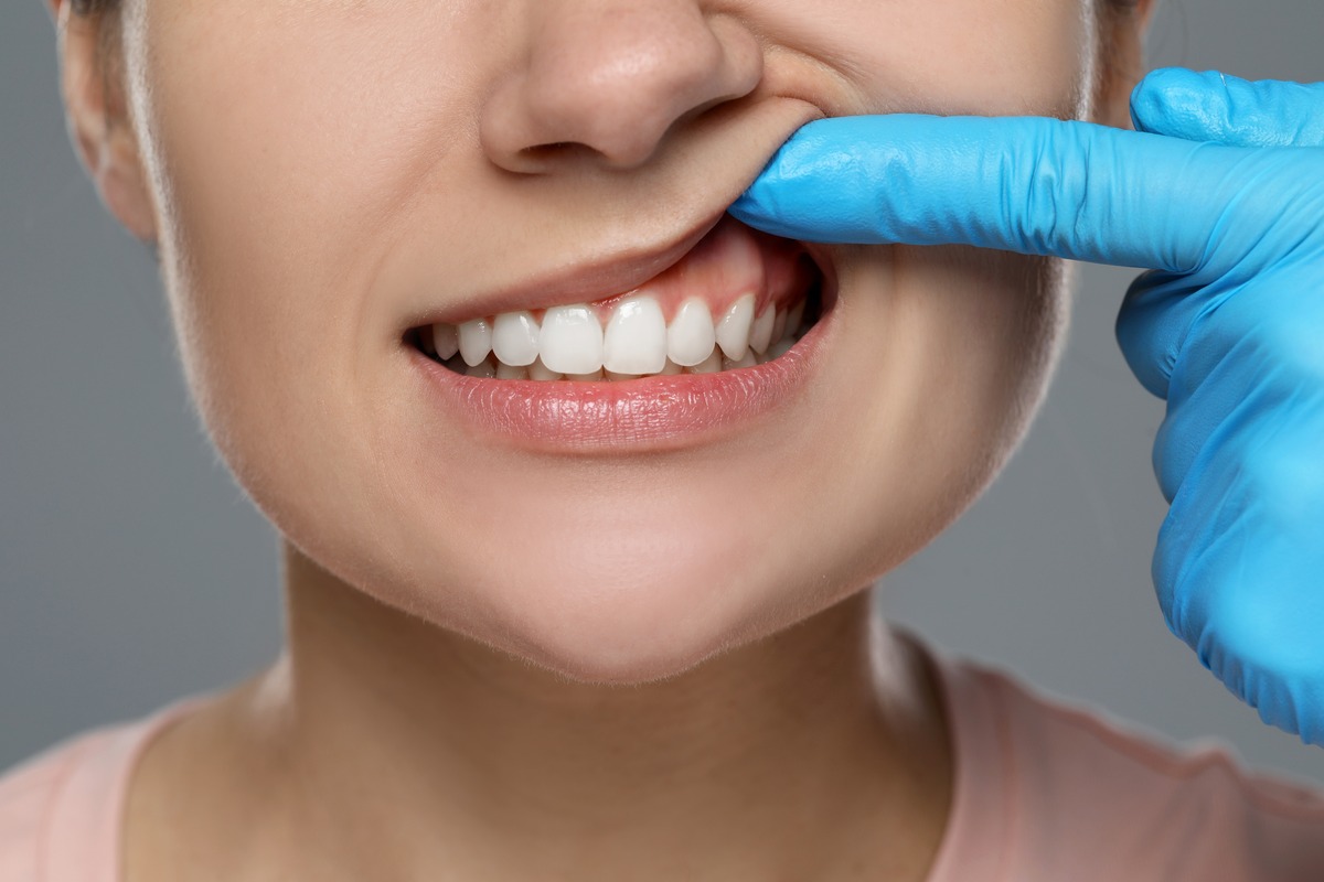 Woman undergoing dental examination with a gloved hand gently pulling back her lip to reveal bright, white teeth, illustrating the professional teeth whitening process at Citrus Smiles Dental Studio.