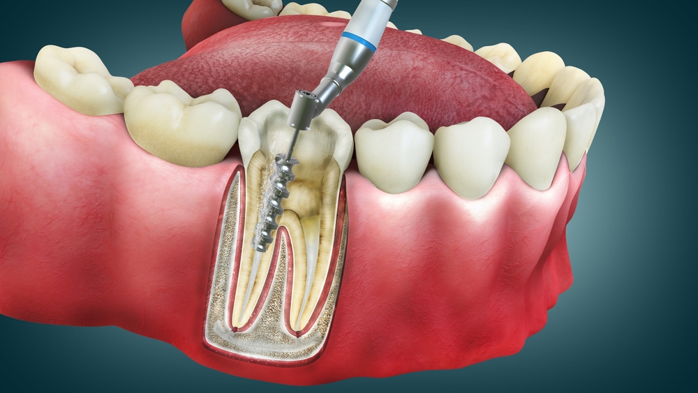 3D illustration of root canal therapy procedure, showing dental tools removing infected pulp tissue from a tooth's root canal, highlighting the clinical process involved in endodontic treatment at Citrus Smiles Dental Studio.