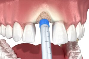 3D scan of jawbone illustrating bone grafting procedure and material placement.