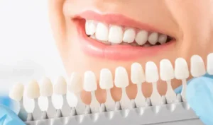 teeth whitening, before and after