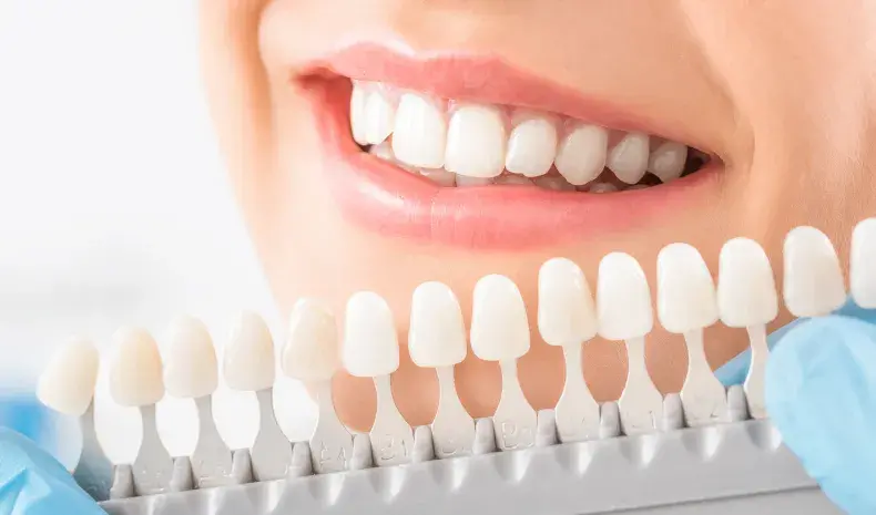 porcelain veneers at Citrus Smiles Dental Studio