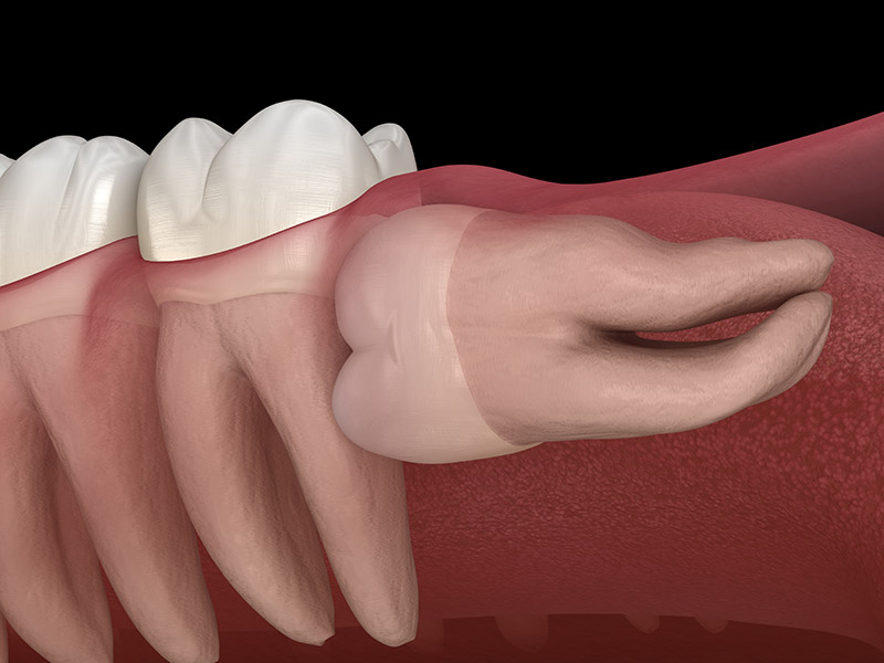 impacted wisdom teeth