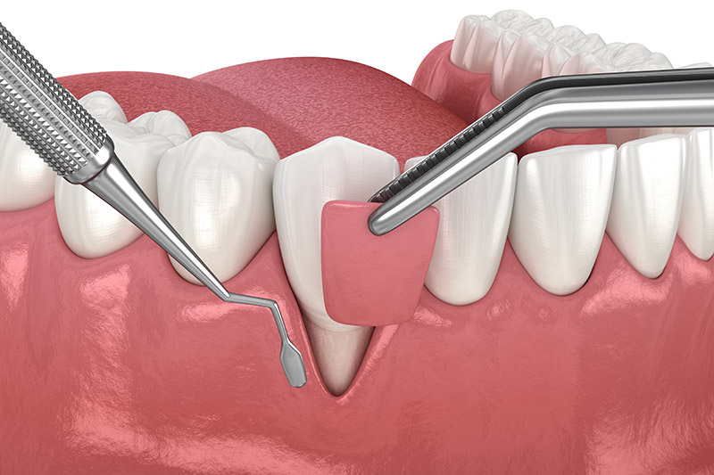 oral surgery at Citrus Smiles Dental Studio