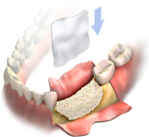 Diagram illustrating sinus lift bone grafting procedure and implant placement.