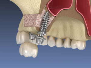 Dental implant and bone graft illustration showing sinus lift procedure.