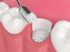 Dental bone graft material placement in a tooth socket for implant readiness.