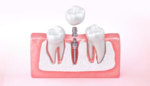 dental implant