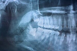 x-ray showing upper and lower impacted wisdom teeth