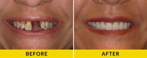 before and after results for smile makeover