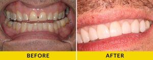 before and after results for dental veneers