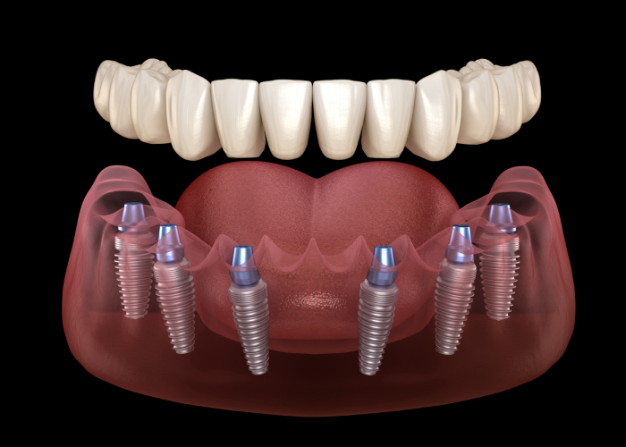 All on 4-6 implants
