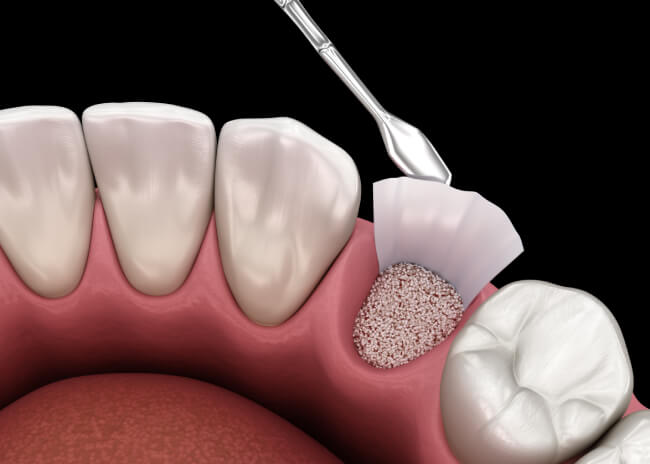 Bone Grafting