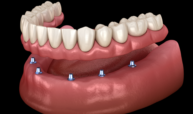 dentures-