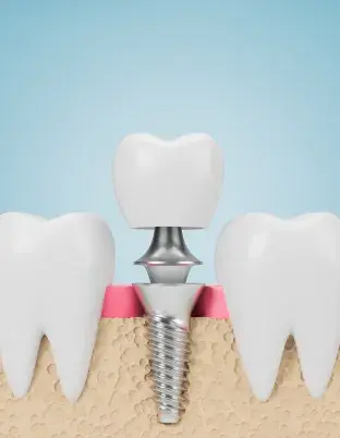 Implant Dentistry