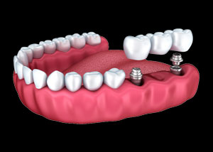 2 Implant Lower Overdenture