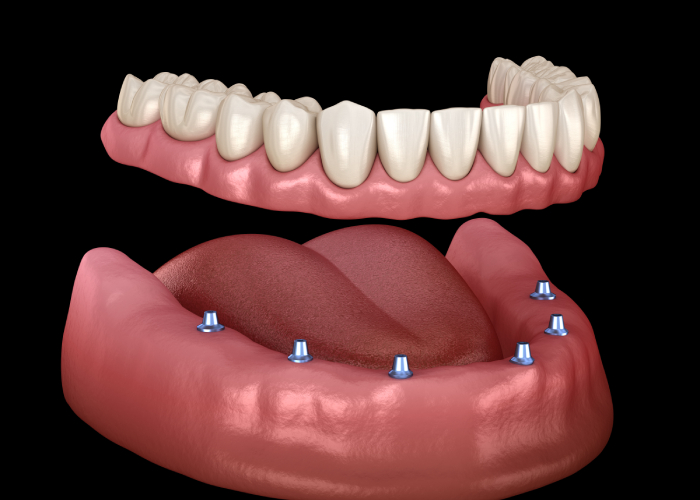Implant Supported Dentures