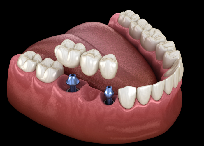 Multi Tooth Bridge