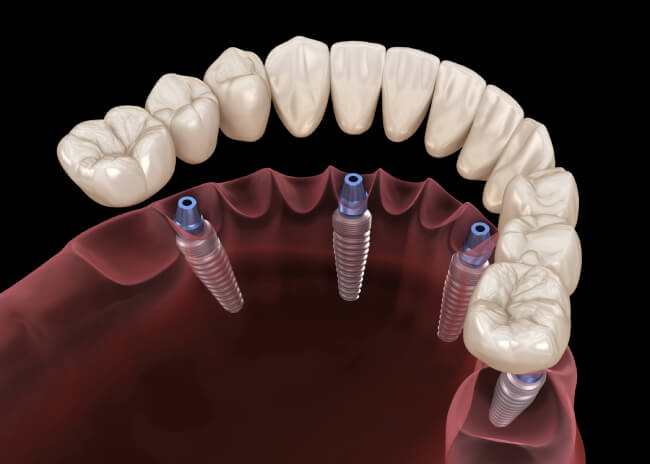 4 Implants Overdenture (Snap On Dentures)
