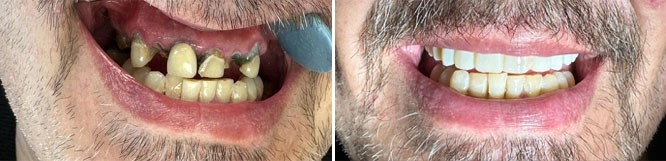 Same-Day Permanent Teeth