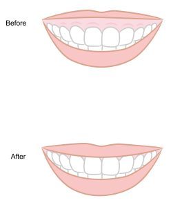 before and after crown lengthening treatment for a gummy smile