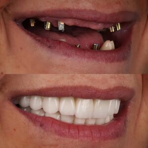 Before and after images of dental implants showcasing missing teeth with titanium posts above and a complete, natural-looking smile below, illustrating the transformative effect of dental restoration at Citrus Smiles Dental Studio.