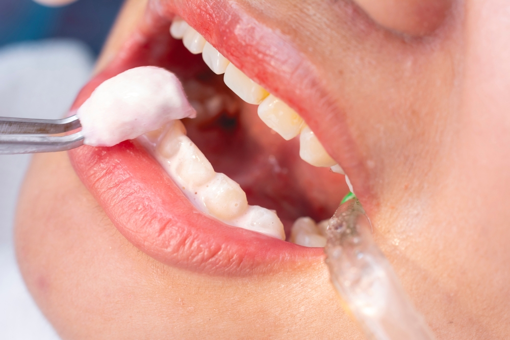 teeth whitening application