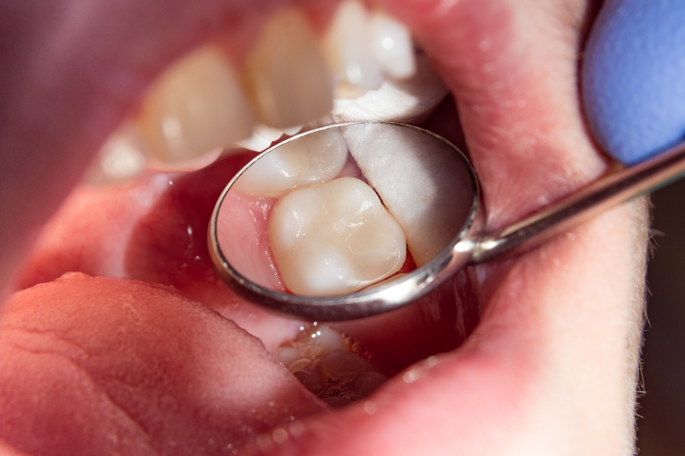 examining  back teeth 