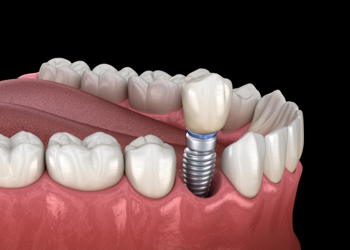Single Implants